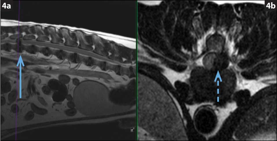 Figure 4. T2-weighted MRI of the spine in a dachshund with intervertebral disc herniation; sagittal view (4a) and transverse view at the level of the disc herniation (4b). Note the dehydration of the disc (blue arrow) and the disc herniation (dashed blue arrow) causing compression of the overlying spinal cord.