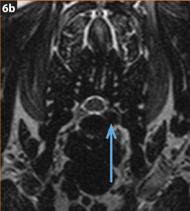 Figure 6b. It was diagnosed with Hansen type-one lateralised C5 to C6 intervertebral disc herniation, treated with a foraminotomy. The dachshund is the chondrodystrophic breed associated with the higher risk of intervertebral disc herniation and can present with various clinical signs, ranging from pain (cervical or thoracolumbar) to paresis/plegia, urinary/faecal incontinence and loss of “deep pain” sensation.