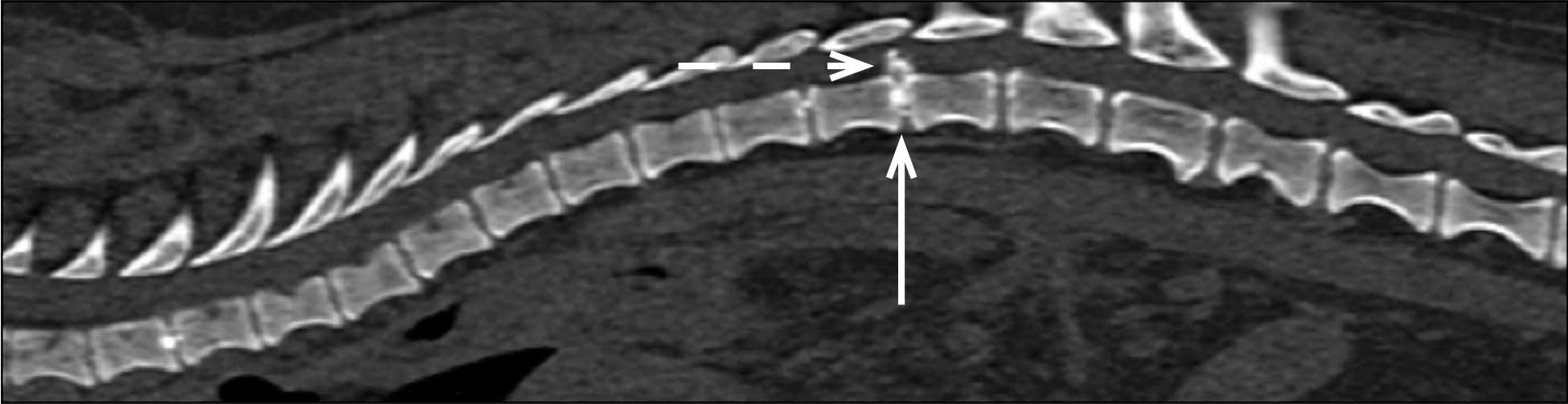 Figure 1. Reconstructed sagittal CT image of the spine in a dachshund with intervertebral disc herniation. Note the abnormal disc calcification (solid white arrows) caused by chondroid metaplasia and herniation into the spinal canal (dashed arrow).