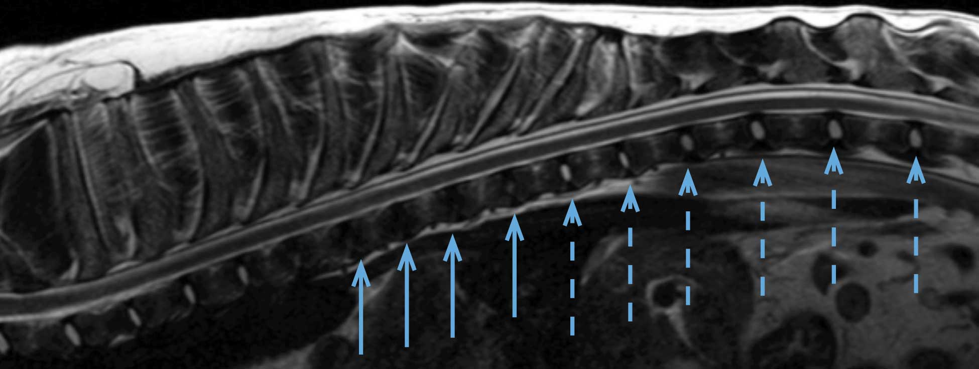 Figure 3. Sagittal T2-weighted MRI of the spine in a cocker spaniel. Note the dehydration of some of the discs (solid blue arrows) corresponding to chondroid metaplasia, compared to normally hydrated discs (dashed blue arrows).