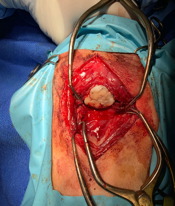 Figure 3. Polymethylmethacrylate was placed over the titanium mesh to avoid excessive scar tissue formation after surgery