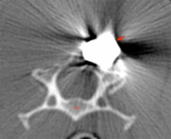 Figure 2a. Transverse CT image at the level of C4 vertebra, pre-bullet removal. A metal artifact is depicted (red arrow) as bright and dark streaks at the level of the right dorsal lamina of the C4.
