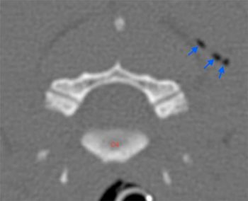 Figure 2b. Transverse CT image adjacent to C4 vertebra showing several small gas attenuating foci throughout the soft tissues (blue arrows) secondary to the gunshot injury.