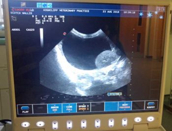 Ultrasound image of the perirenal pseudocyst.