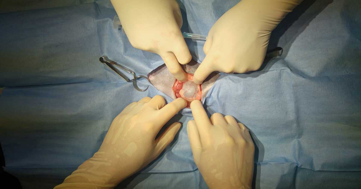 Appearance of the pseudocyst following midline celiotomy.