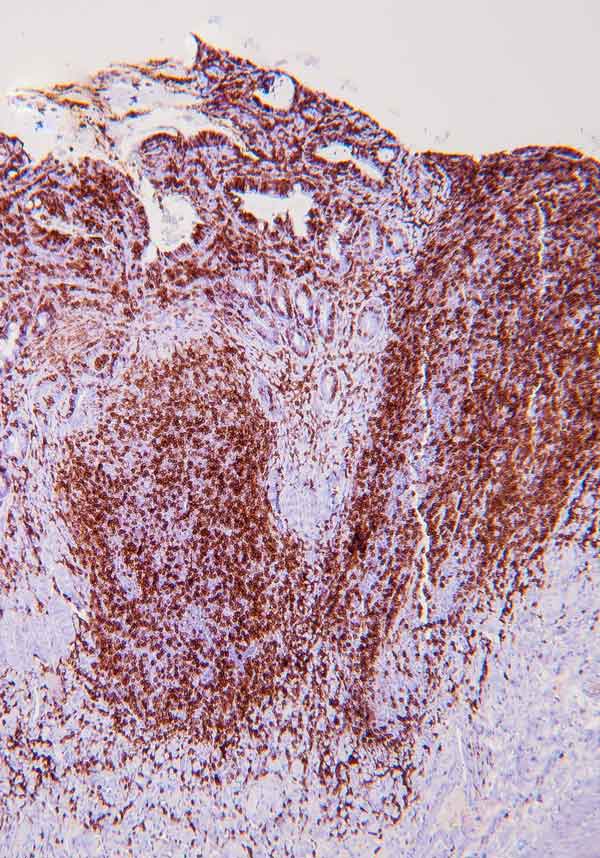 Immunohistochemistry of low-grade intestinal T-cell lymphoma in a cat. Note the presence of dense clusters of CD3 labelling lymphocytes in the mucosa and submucosa. Image: Daniel Borràs Murcia