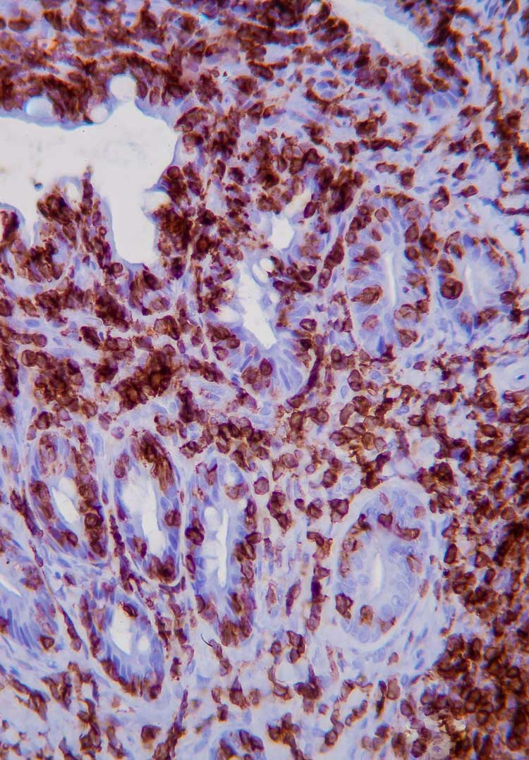 Immunohistochemistry of low-grade intestinal T-cell lymphoma in a cat. Note the presence of dense clusters of CD3 labelling lymphocytes in the mucosa and submucosa. Image: Daniel Borràs Murcia