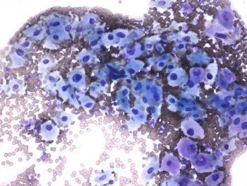 Figure 2a. Well-differentiated squamous epithelial cells (Wright-Giemsa 40×).
