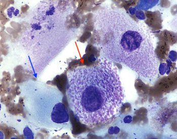 Figure 2b. Well-differentiated squamous epithelial cells (Wright-Giemsa 100×).