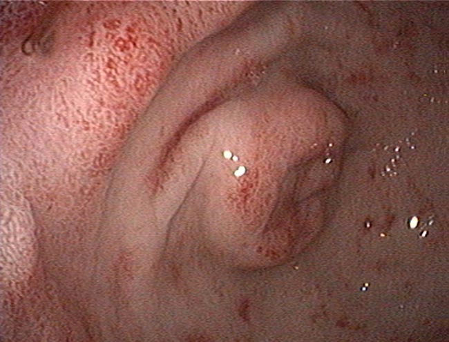 Gastroscopy in a dog with mild lymphoplasmacytic gastritis.