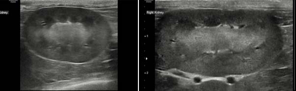 Figure 3. Left and right kidneys of a 10-year-old female neutered domestic shorthair cat with inflammatory bowel disease. Left and right kidneys demonstrate poor corticomedullary definition. Bilateral ultrasonographic abnormal kidney appearance consistent with chronic kidney disease (CKD) was incidentally noted. This cat was diagnosed with stage one CKD. 