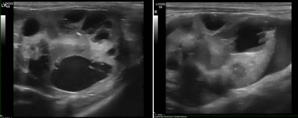 Figure 4. A non-azotaemic six-year-old female neutered domestic shorthair cat presented for further investigation of renomegaly on abdominal palpation. This cat was diagnosed with polycystic kidney disease and stage one chronic kidney disease. Distorted kidney contour, reduction in corticomedullary volume and presence of multiple cystic structures in both kidneys can be observed.