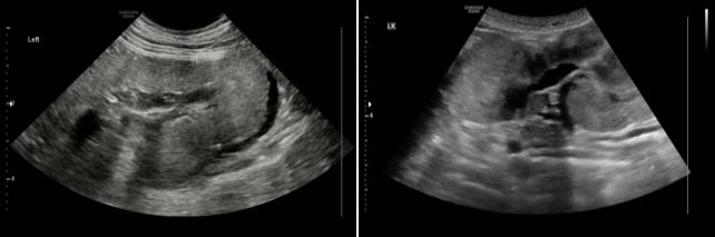 Figure 5. A one-year-old female, neutered boxer dog presented for routine ovariohysterectomy with reports of polydipsia. Scans show disformed, small kidneys with pyelectasis and absence of corticomedullary definition. Stage two chronic kidney disease was noted on blood and urine assessment. A diagnosis of renal dysplasia was made.