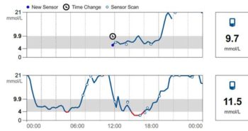 An example of an interstitial glucose curve in an unstable diabetic being treated with twice-daily lente insulin.