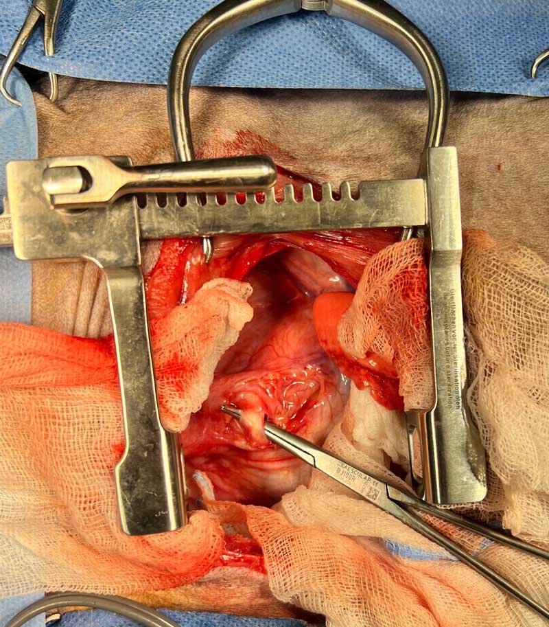 The constrictive ligamentum arteriosus has been dissected away from the underlying oesophageal wall via a left fourth intercostal thoracotomy.