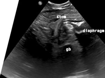 Figure 1. Frozen image of ultrasound scan showing herniation of stomach and gall bladder through the diaphragmatic defect.