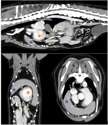 Figure 2. Three CT scan views of the thorax showing herniated viscera extending through the diaphragmatic defect (yellow arrow) into the pericardial sac. The spleen (blue star) can be seen extending around the cranial border of the heart (orange star).