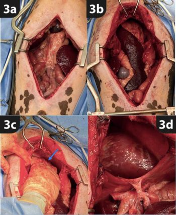Figure 3. Intraoperative photos. 3a. Midline coeliotomy showing the herniated abdominal viscera extending cranial into the pericardium. 3b. Improved exposure after caudal median sternotomy, showing the spleen and omentum extending through the diaphragmatic hernia into the pericardium. 3c. Caudal retraction of the spleen and omentum revealing an adhesion through the defect within the cranial pericardium (arrow). 3d. Thoracic cavity after removal of the herniated abdominal viscera.