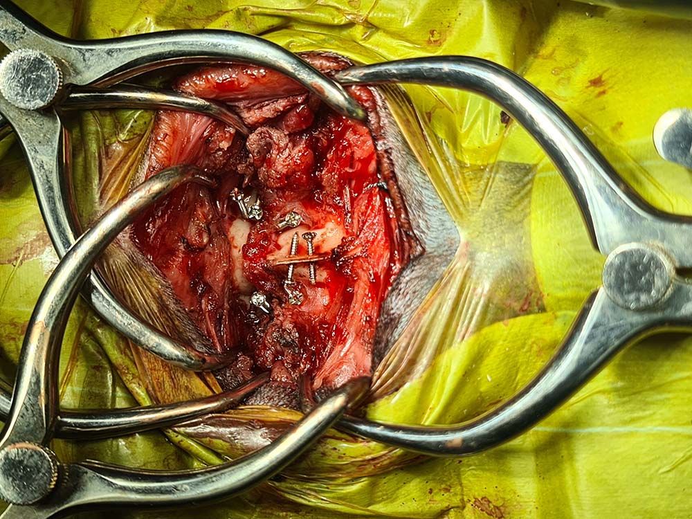 Intraoperative picture with all screws placed, ready for the surgical cement.