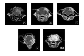 Figure 1. In all images, the patient’s left side is on the right side of the image. An ill-defined, irregular fluid‑attenuated inversion recovery (FLAIR) hyperintense lesion is present, affecting both grey and white matter of the left parietal lobe. The parenchymal hyperintensity becomes less marked and more heterogenous just deep to a defect in the calvarium (a). Bilateral regions of marked contrast enhancement in the parenchyma of the parietal lobes are observed (b, c and d). Overlying each of these lesions are disruptions in the continuity of the calvarium, with severe inward deviation of a fragment of calvarium on the left side (c). Bilateral temporal muscle and SC tissue swelling is present (all images), FLAIR hyperintensity (a) and contrast enhancement (b, c and d), much more marked on the left side. Mass effect is shown by midline shift and compression of the lateral ventricles and left side of the thalamus (visible in all images). 