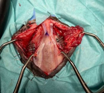 Figure 2. Note that rostral aspect of the patient is to the top of the image. Intraoperative image of both parietal muscles elevated allowing exposure of the two titanium meshes covering the bone defects of the skull. 