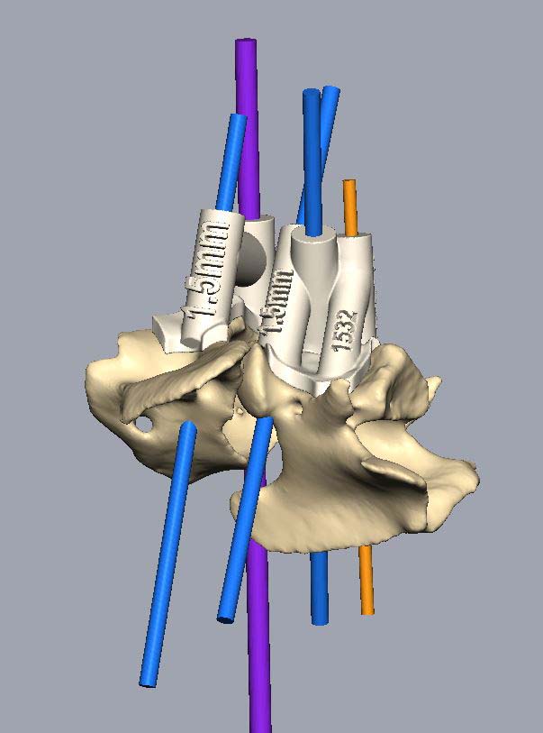 Computer-aided design lateral view of C1 and C2 vertebrae, with drill guides in situ and pilot hole trajectories planned across. Image © Vet3D / www.vet3D.co.uk