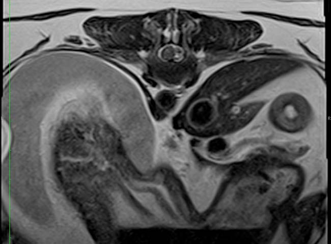 T2-weighted transverse MRI scan.