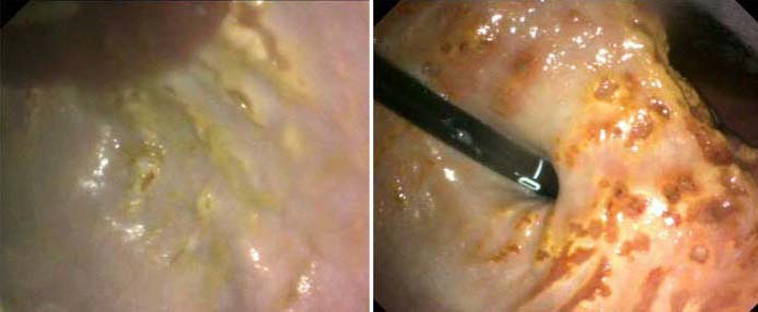 Figures 2a (left) and 2b. Equine squamous gastric disease. 