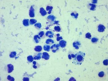 Figure 2. Cytology of the joint fluid.