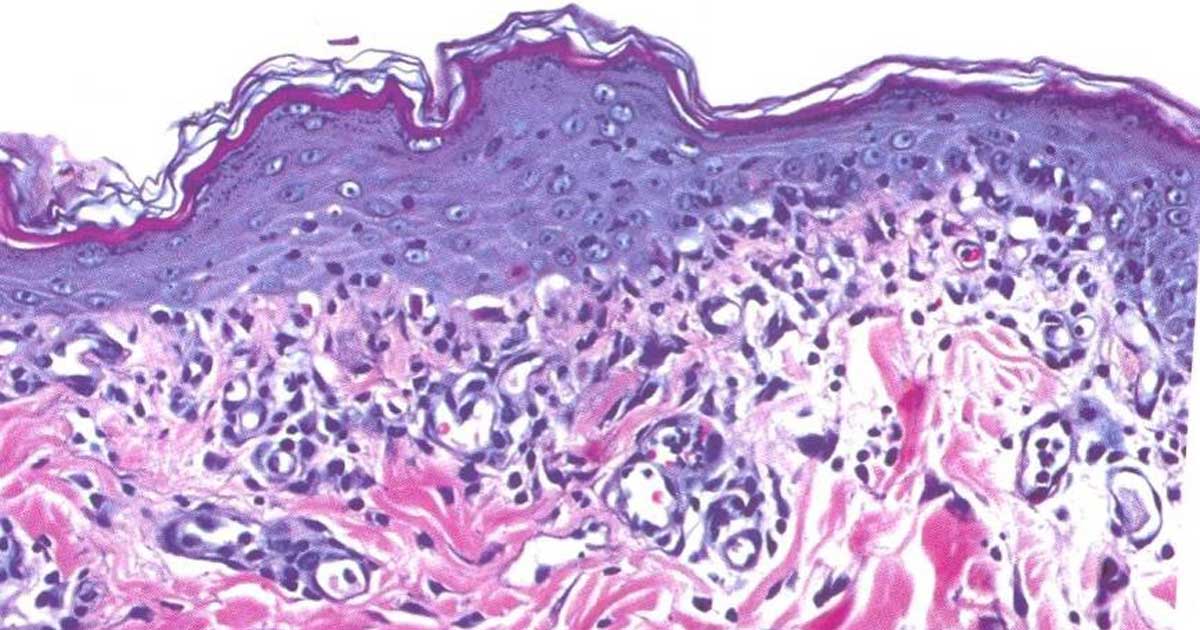 Figure 1. Interface dermatitis. The epidermis is thickened, apoptotic keratinocytes are present and a band of lymphocytes is present in the upper dermis.