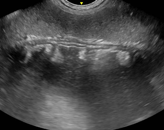 Figure 1. Longitudinal plane view from the left sublumbar fossa showing the spleen in the near field and the wall of the gastric fundus. The stomach is dilated with fluid content and was hypomotile. 