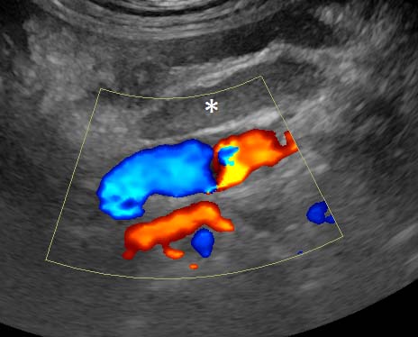 Figure 2. Longitudinal plane view from the right flank showing the mesenteric vein, mesenteric artery and an adjacent jejunal lymph node (asterisk). Colour Doppler reveals normal flow in the vessels.