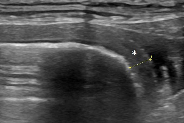 Figure 3. Longitudinal plane view of the left colon orad to the torsion. The colonic wall (asterisk) is thickened and lacks normal layering. A small abdominal effusion is present.