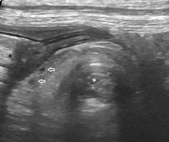 Figure 4. The “whirl” or “whirlpool” sign at the point of colonic volvulus as seen in the frontal (dorsal) plane. The proximal colon (black asterisk) enters the spiral and is twisted about a centre of rotation (white asterisk). The associated mesentery and vessels (white arrows) are also involved.