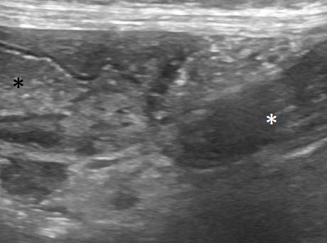Figure 5. Longitudinal plane view of the left colon showing a dilated section proximal (black asterisk) and an empty part distal (white asterisk) to the volvulus.