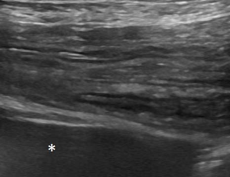 Figure 6. Longitudinal plane view of the empty part of the left colon distal to the volvulus.