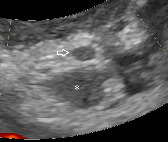Figure 7. An enlarged left colic lymph node (asterisk) and caudal mesenteric vessel (arrow). The vessel is thrombosed and demonstrates no flow on power Doppler. 