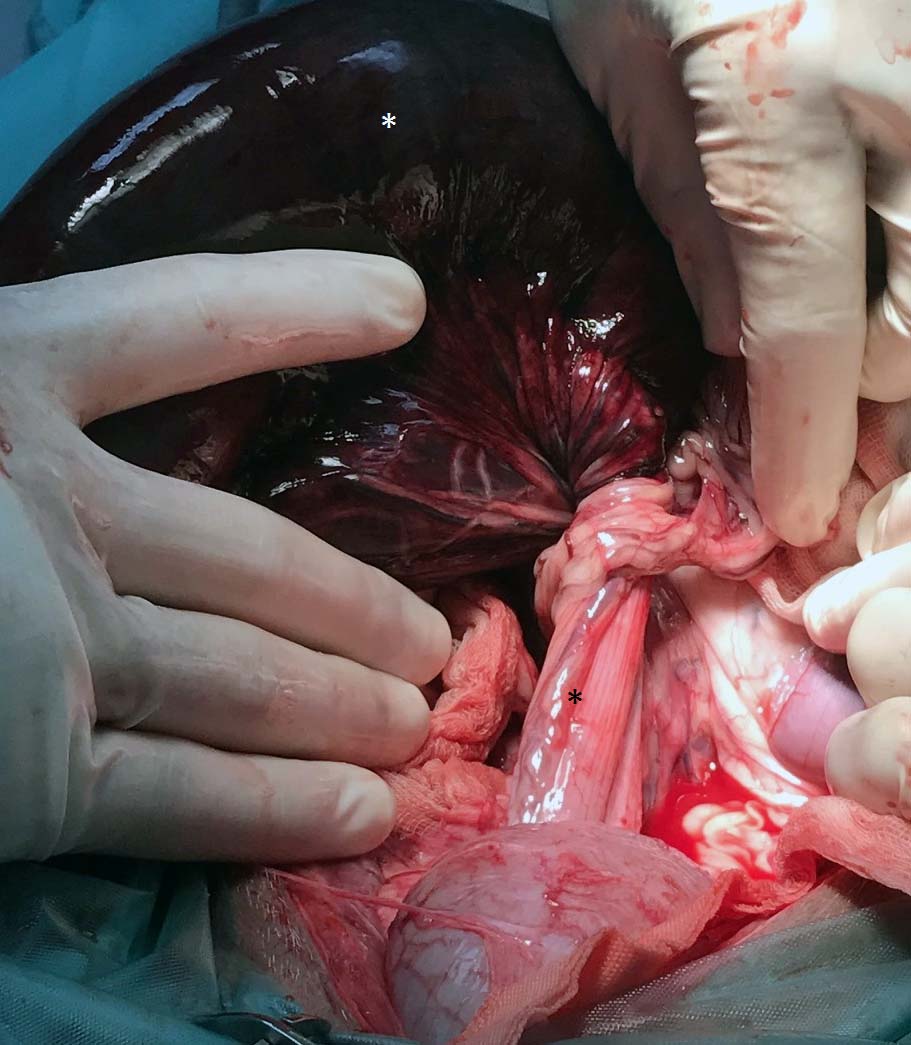 Figure 8. At laparotomy, a twist of more than 360° in the root of the mesocolon was confirmed. Stark contrast is present between the torsed colon (white asterisk) and the descending colon distal to the volvulus (black asterisk).