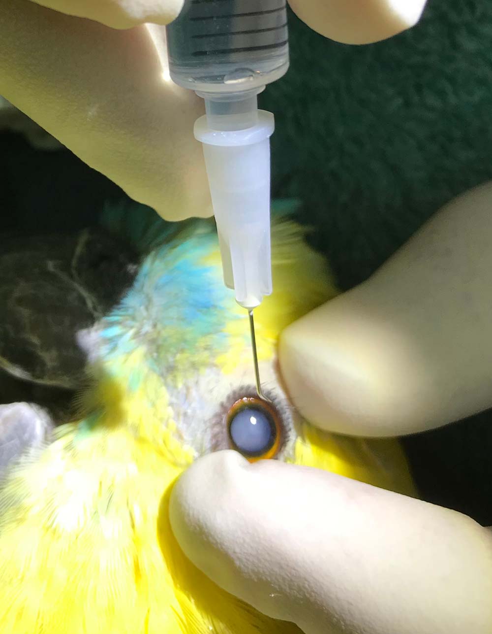 Figure 2. Incising the lens capsule and breaking down the cataract material using the hypodermic needle “fish hook”.