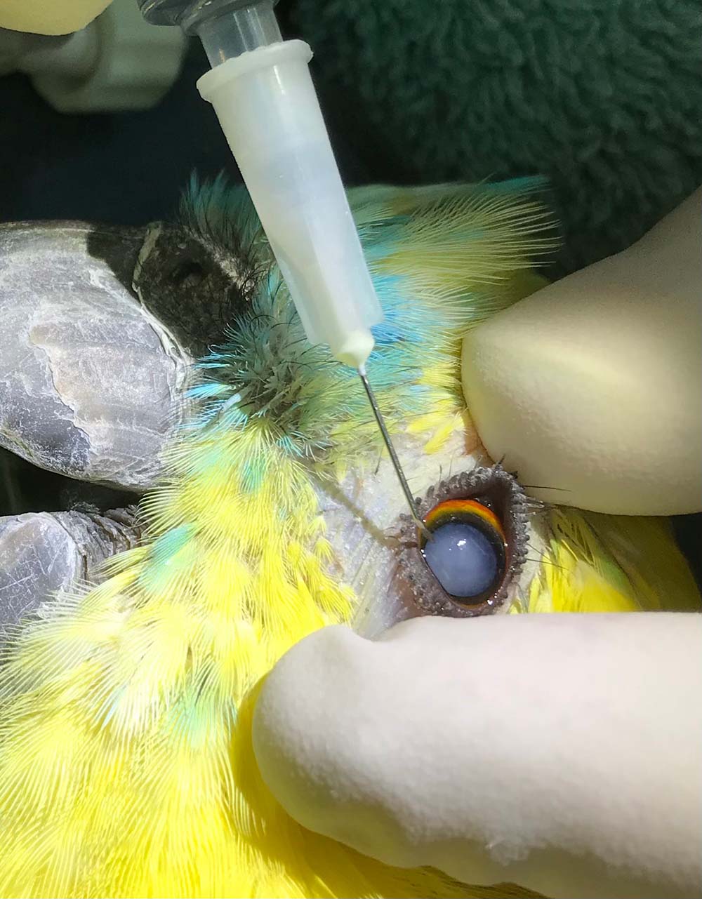 Figure 3. Incising the lens capsule and breaking down the cataract material using the hypodermic needle “fish hook”.