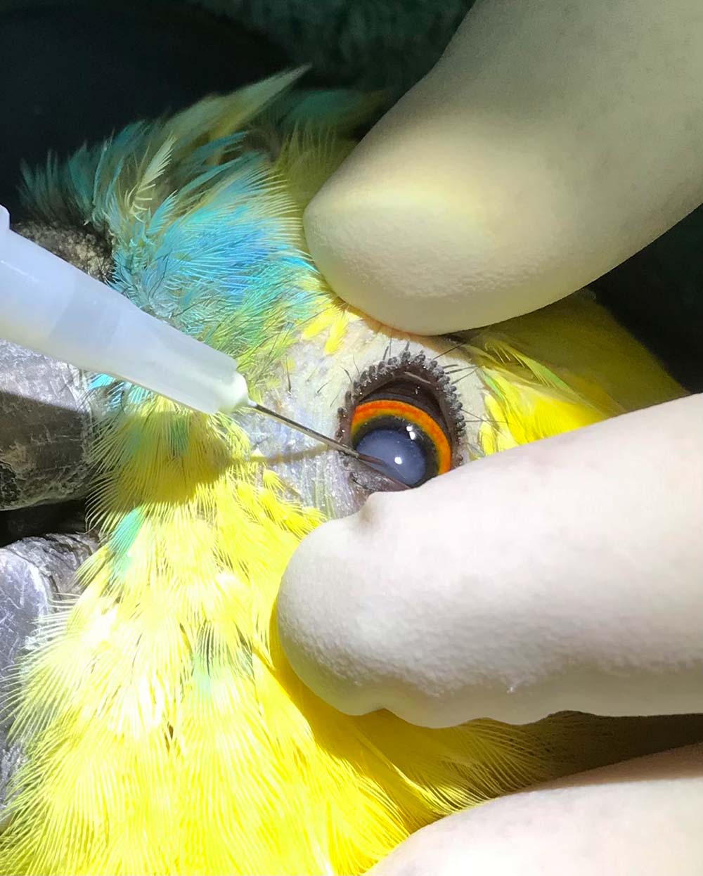Figure 4. Incising the lens capsule and breaking down the cataract material using the hypodermic needle “fish hook”.