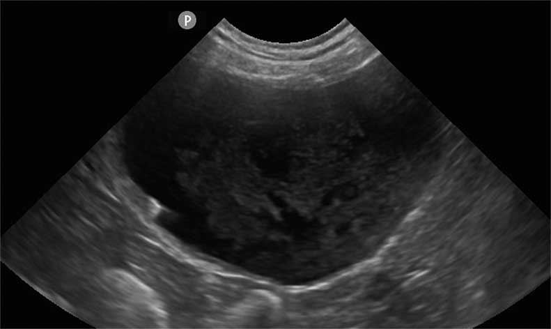 Figure 10b. Henry’s bladder on ultrasound.