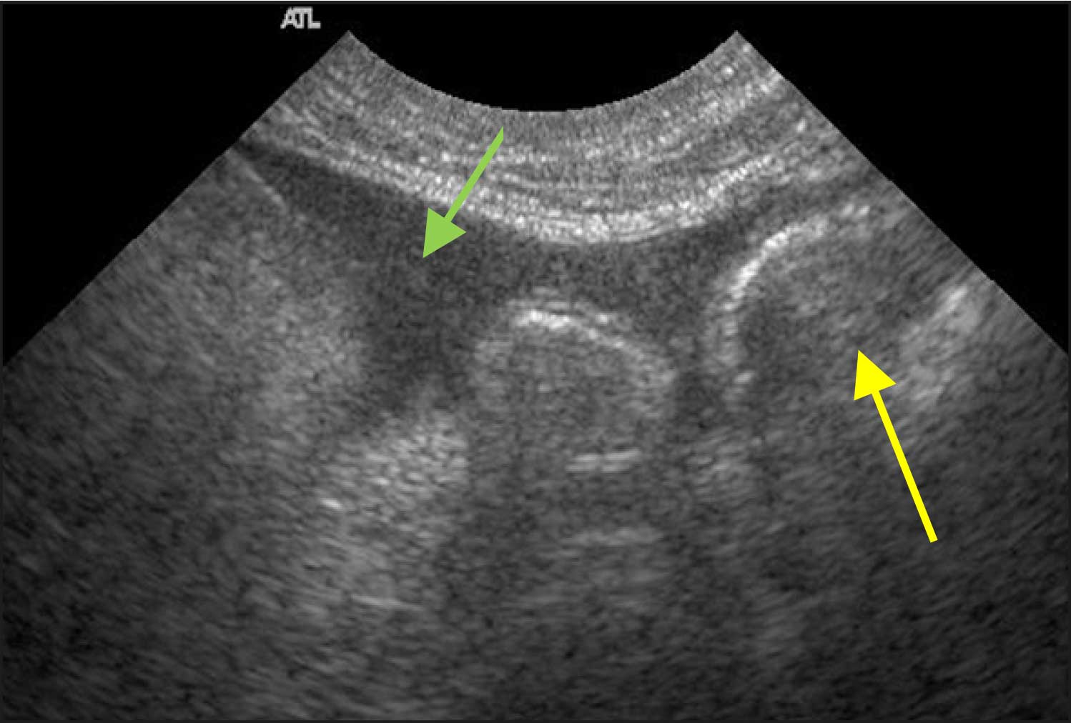 Figure 8a. Mimi’s abdominal ultrasound. Dilated small intestine loops (yellow arrow) and free fluid (green arrow).