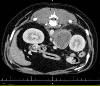 A section of Daisy’s CT scan clearly showing the large adrenal tumour, which was successfully removed by Cave Veterinary Specialists' head of surgery Malcolm Jack.