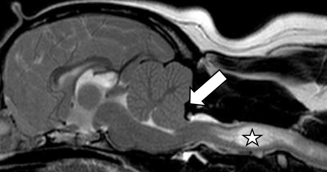 Figure 2 (below). MRI T2-weighted sagittal image of brain and spinal cord in which fat and fluid are bright, bone is black and brain and spinal cord are grey. The arrow shows Chiari-like malformation and the star shows the syringomyelia.
