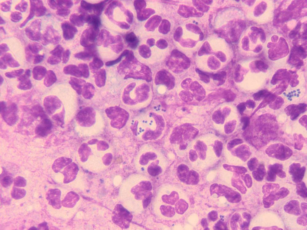 Figure 13. Cytology from a pustule, showing neutrophilic inflammation and phagocytosed cocci in a case of bacterial folliculitis.