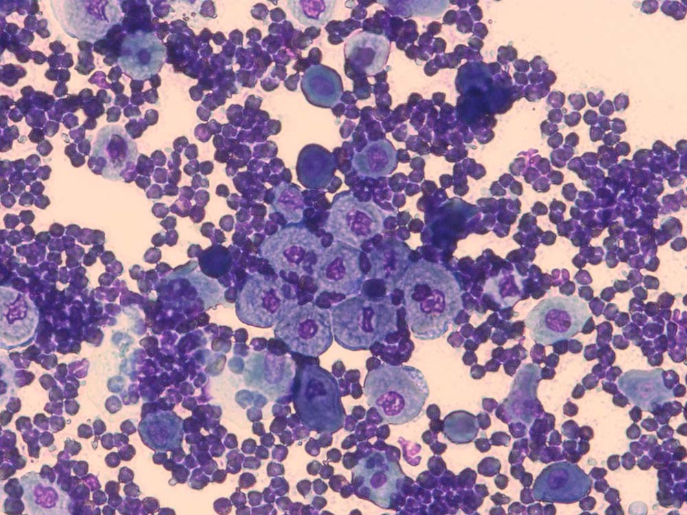 Figure 14. Cytology from the contents of a pustule of a dog, showing neutrophilic inflammation and acantholytic keratinocytes in a case of pemphigus foliaceus.