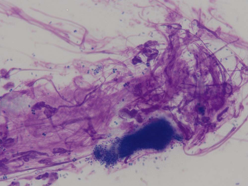 Figure 9. A tape impression from a dog showing evidence of bacterial infection (cocci) and neutrophilic inflammation.