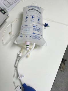 Figure 2. Equipment set up for wound irrigation: a 1L fluid bag in a pressure cuff, a giving set and a 21G needle. 