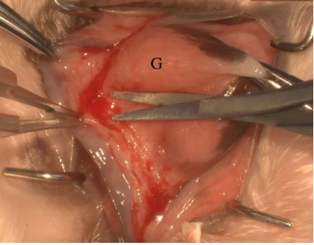 Figure 4a. Incision anterior to the prolapsed gland labelled “G”.